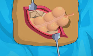 Operate Now: Appendix Surgery